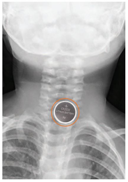 Hearing Aid Battery Safety and Children Hearing Aid Battery Safety and Children