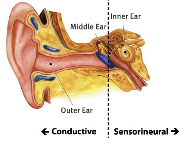 Types of Hearing Loss